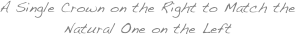 A Single Crown on the Right to Match the Natural One on the Left